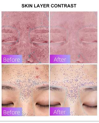 ซื้อ Blue Light Acne Treatment Mask with Intelligent Timer – Manufacturer Direct Supply, Appearance Patent Included การผลิตออนไลน์